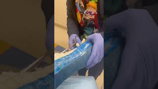 Cutting my cast off