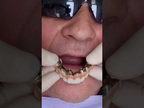 ALL ON 4 - Good or Bad??? #allon4dentalimplants #fullmouthrestoration #brushyourteeth