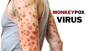 What is Monkeypox and how it spreads, prevention and cure Dr. Aryan Mishra