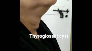 Thyroglossal cyst