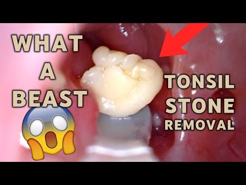BEAST of a Tonsil Stone Removal | AIM 17
