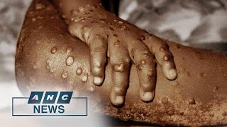 WHO says monkeypox poses ‘moderate risk’ to global public health | ANC