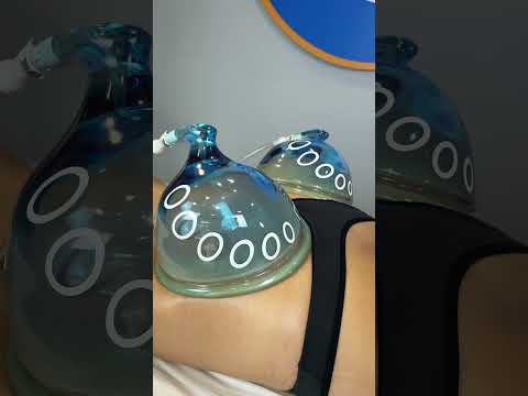 Delfín Buttocks Lifting