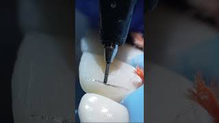 Direct anterior composite restoration requires precision, skill and attention to detail. #composite