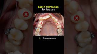 How to fix crooked teeth #braces #orthodontist #dentist #dentistry