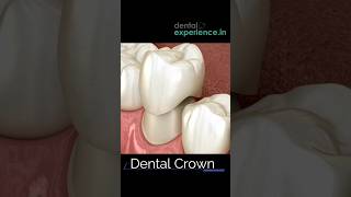 Dental Crown | Zirconia Teeth Crown | Tooth Cap | DentalExperience.