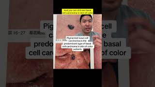 Dermatologist Explains: The Most Common Skin Cancer- Basal Cell Carcinoma
