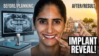 My First Dental Implant Experience with Dr. Rajat Sachdeva – Delhi’s Best!"