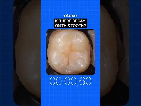 #dental #dentist #dentistry #decay #cavity #dentistryworld