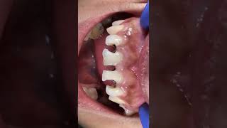 Direct Restoration Composite.