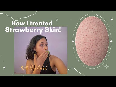 How I Treated Strawberry Skin (Keratosis Pilaris) !