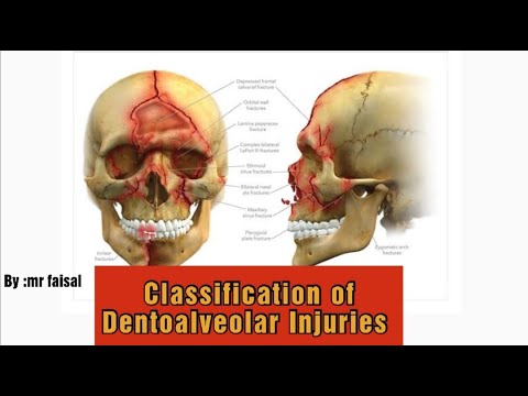 Dento-Alveolar Injuries Part-2