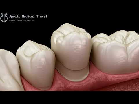 Animated Dental Crown Procedure | Apollo Medical Travel