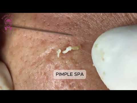 Blackheads Removed with Force – Nose Popped Like Never Before|Pimple Spa