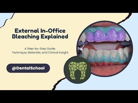 External In-Office Bleaching Explained: A Step By Step Guide