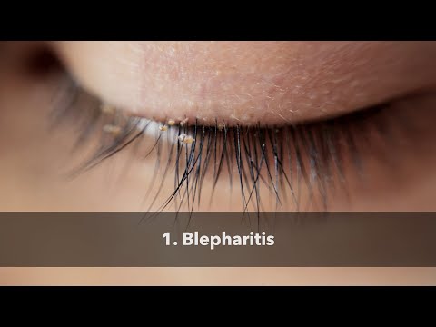 Blepharitis
