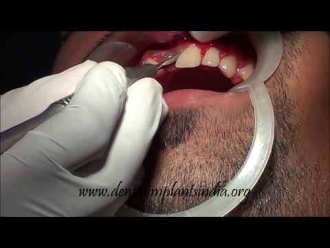 how to use periotome For Extraction of upper central incisor