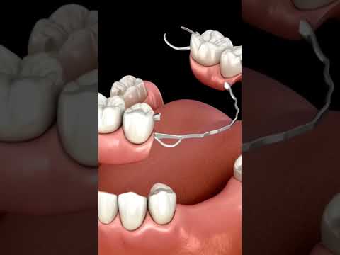 Animated Removable Partial Denture