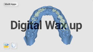 Designing temporary with digital wax up.