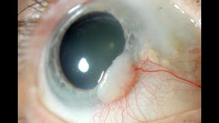 Biopsy of conjunctiva CPT code - simplify medical coding