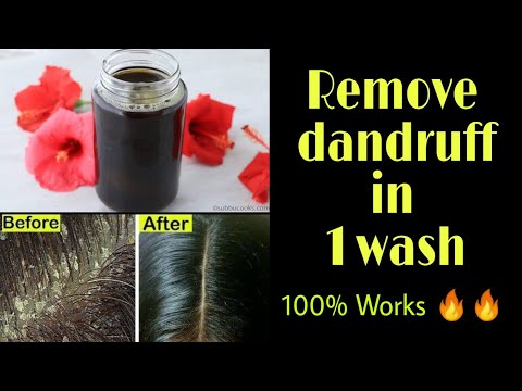 how to control dandruff in winter | get rid of dandruff permanently | The Beginner Girl