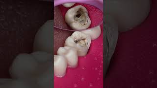Dentist Looking Tooth Cavity #dentist #satisfying