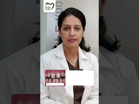Some common treatments for gaps between teeth #dentalhealth #dentalcaretips #dentalawareness