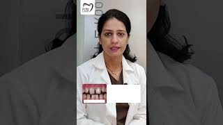 Some common treatments for gaps between teeth #dentalhealth #dentalcaretips #dentalawareness