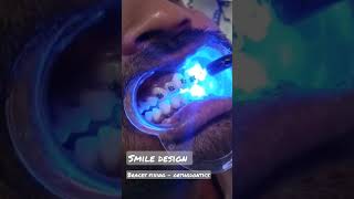 smile design - #dentist #dental  #braces  #orthodontist #brackets #dentaltreatments #smilecorrection