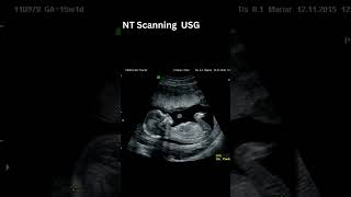 NT Scan USG #ntscan 15 weeks scan