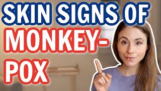 MONKEYPOX OUTBREAK 2022 SKIN SIGNS *UPDATE* DERMATOLOGIST @DrDrayzday