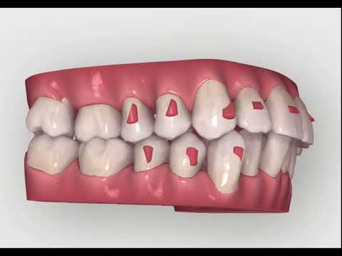 Invisalign Tooth Movement - JB White DDS Las Vegas