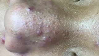  ASMR Deep Facial Cleansing for Clear Skin | Acne, Blackheads & Whiteheads#asmr 