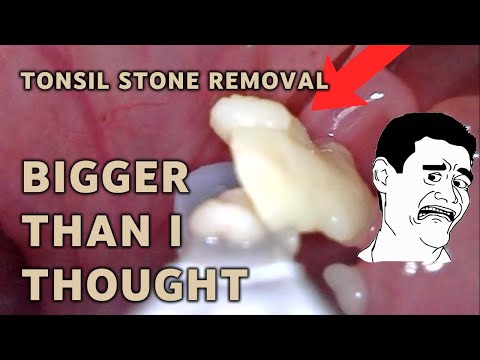 Tonsil stone extraction MUCH bigger than I thought! | AIM 18