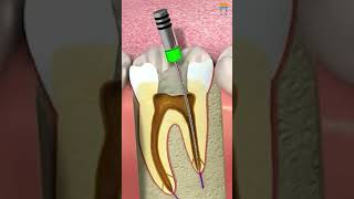 How to Use Gutta Percha for Root Canal Sealing! 🦷 #shorts