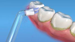Waterpik Plaque Seeker Animation   QuickTime