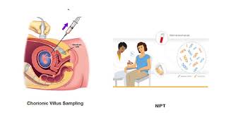 Learn more about the NT scan and its role in detecting Down syndrome in a fetus
