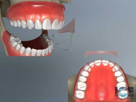 Hawley Retainer Upper