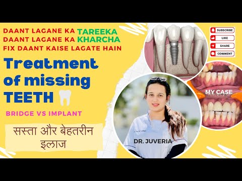 Treatment of FIX TEETH? नये दांत लगवाने के 3 परकार | Tarika / Kharcha? Dental Implant VS Bridge
