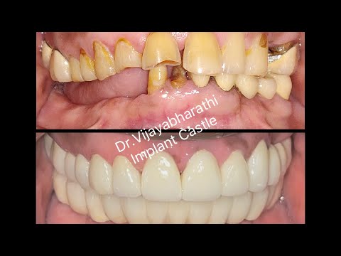 Full Mouth Rehabilitation / Smile Designing /Implant Supported Fixed Denture #dentistnearme #dentist