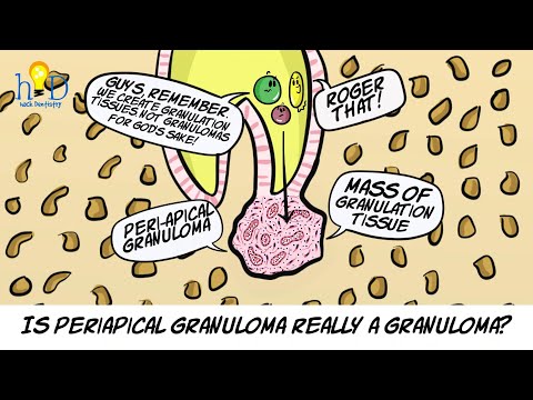What is periapical granuloma?