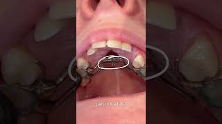 Expander Instructions: How To Activate The RME Screw (Step-By-Step Guide) 🦷