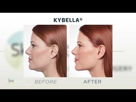 Skin Artisans- Kybella® Treatment