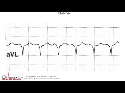 ECG Academy ChalkTalk 406