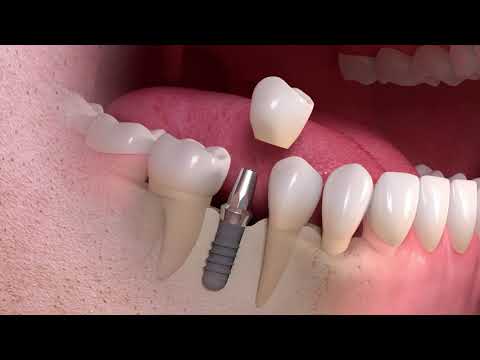 Elanora Dentistry - Implants