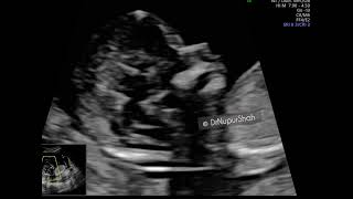 Measuring the Nuchal Translucency (NT) @drnupurshah 