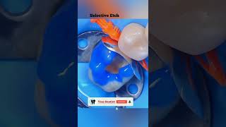 Tooth restoration 😲😲| Detailing tooth structure | case 21 | Your Dentist #shots  #shortvideo #shorts