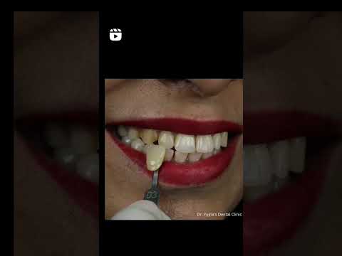 Teeth Whitening in 40 minutes #smilemakeover #teethwhitening #dentist