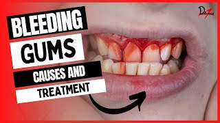 Bleeding Gums Causes & Treatment