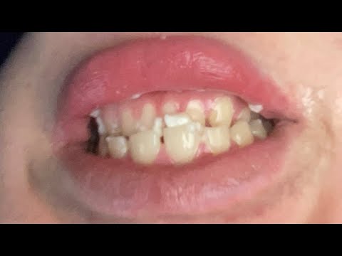 Australian Talking Mouth in: How To Smile